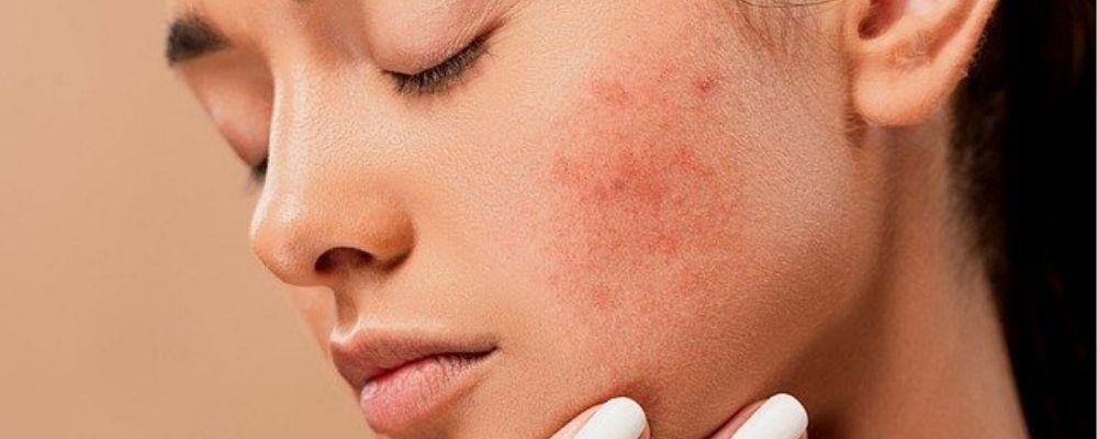 how-to-prevent-acne-from-whey-protein-fitshopee